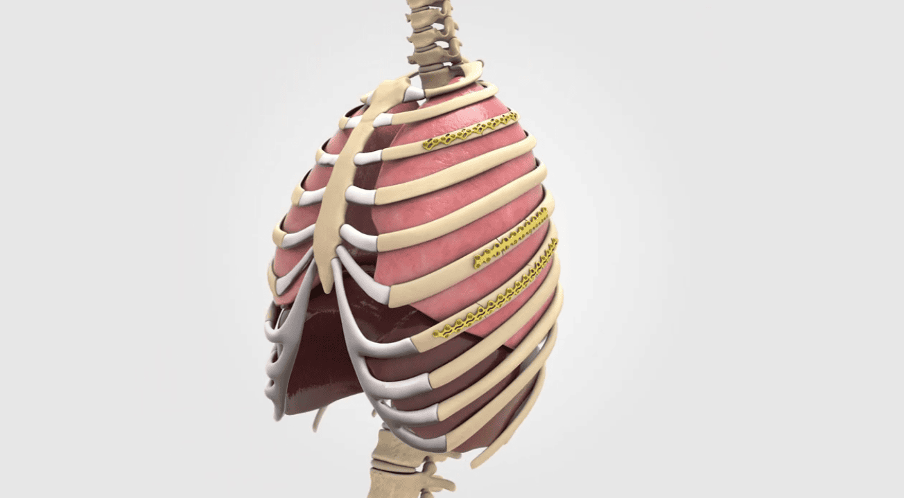 L1 Accessory Rib L1® Rib osteosynthesis system featuring CB3 technology - CADS