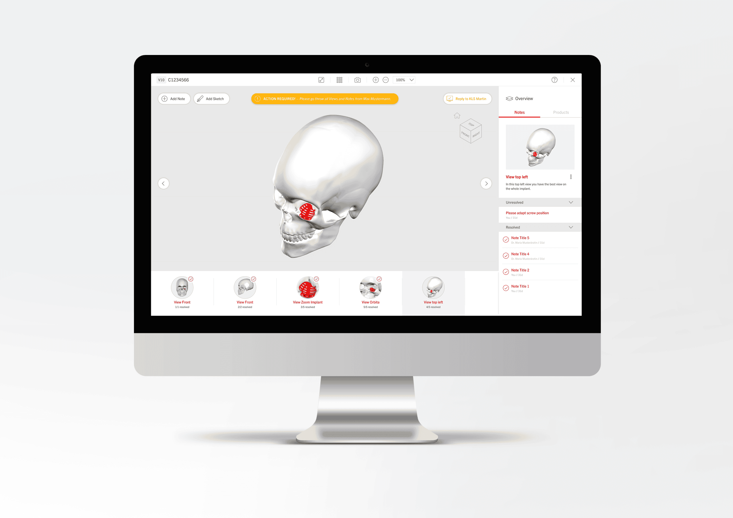 3D-Kiefermodell auf Computerbildschirm mit IPS Gate.