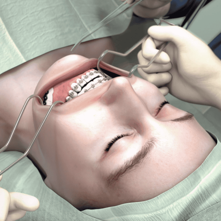 3D Rendering von Kiefer-OP